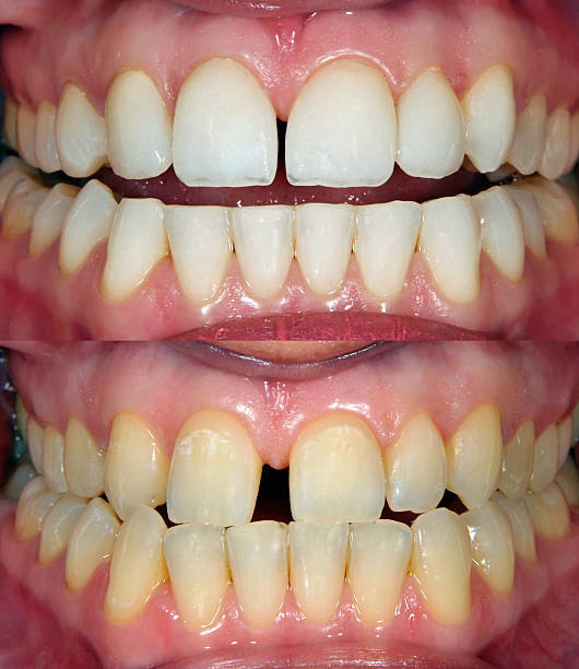 teeth straightening